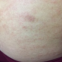 问下最近肚皮很痒，挠得出粒粒了，这两天腿上也开始了，有知道这是什么原因导致，属于正常吗？