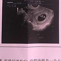 10月8号来月经13号干净。20号打点滴左氧。吃左氧。11月10号怀孕。孩子能要吗