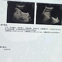 56天没有胎心还有希望吗