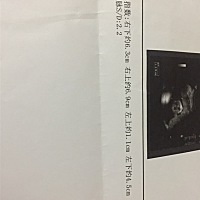 医生说羊水偏多，怎么办