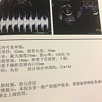 怀孕22周了，希望宝宝健健康康的长大，不知道是男宝宝还是女宝宝，有人能看出来吗？