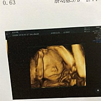 今天大排畸过啦 好开心 照了40分钟 医生说宝宝太活跃了 动来动去 还侧躺着休息照了几分钟 感觉两张都不...