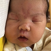 有宝妈知道这个红斑吗？我孩子一出生就有，现在21天了，能退吗？好难过！