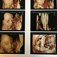 我这个小家伙，一点都不给面子！照四维全程都爬起，还要用小手手挡住自己的脸！还好医生经验丰富，抓拍...