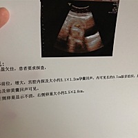 50天的B超，能看出男女吗