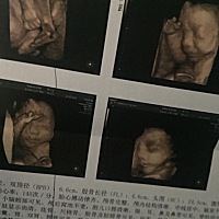 好奇男孩还是女孩，胎儿双肾盂均阔张积液，范围1.0x0.6cm，严重吗？医生说没事，还是会担心