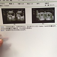 今天去医院检查 医生说只能看见一点点胎芽 都两个月多几天了 好担心 让我过一个星期去检查