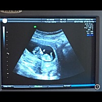 这是十二周去做NT拍的  孕囊是5.3*3.6*1.3   现在快二十二周了 因为我比较喜欢女儿 前两天去做检查 回家...