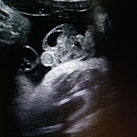 终于安心了，百分百不会翻盘了，传好孕…从怀孕一直压力很大，虽然之前也看过，一直害怕翻盘，一直祈祷...