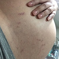 请问一下有经验的孕妈，今天突然发现肚子上出这个，是什么呀