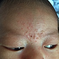 有宝宝会长这个的吗？他们说是胎毒，但感觉好久了还没好，有宝妈知道要擦什么好吗？我擦过婴和膏，但还...