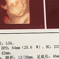 上午去做四维了，宝宝一直趴着不让看脸，医生叫我出去走走再回来照，然后侧着身子才勉强拍到脸。检查结...