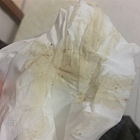 昨天吃了点烧烤。今天吃了烤肉。然后现在褐色分泌物变多了好担心。发图你们别嫌弃我。有经验的告诉我是...