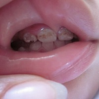 16个月宝宝牙这样怎么办？有没有一样的宝妈啊？