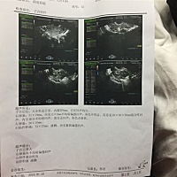 这个可以下结论是宫外孕吗？😥😥😥