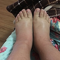 怀孕34周，脚肿成这样了，怎么办？