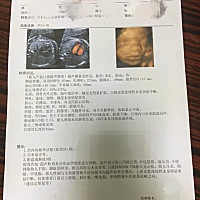 这彩超单看的出是儿子还是女儿吗？