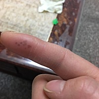 大家知道这手指上长的是什么吗？前天手指有些痛，肿才发现里面有几个红点，今天红点明显了好多，没有被...