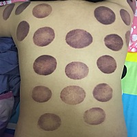 今天拔罐去了……这一身，有没有懂的给解释解释解释