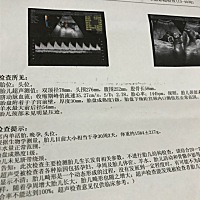 双顶径减去股骨长等于2是男孩还女孩啊？