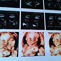 宝宝左肾分离0.7有宝妈一样的吗 ？帮忙看看是男还是女