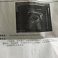 今天下午去检查了，一切正常！就等三个月去建档！