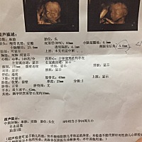 今天出炉的四维  折腾几个小时 爬楼梯爬了一个多小时 ， 医生说让多喝水 多吃青菜！ 另外推荐做心脏B超...