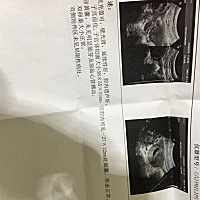 怀孕56天B超报 没有胎芽没胎心...我要不要继续等....你们有过这种情况吗？