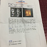 你们都做几次四维彩超啊，我22周做了一次，医生说没啥问题，建议28周再做一次