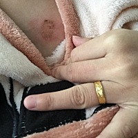 前天晚上不小心被热水烫到 孕妈妈帮我看看可不可以擦药膏 现在又痒又痛 好煩😒😒