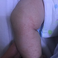 宝宝这是干性湿疹吗