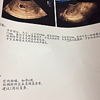 请问有和我这样情况的吗？6周还没有胎心搏动，而且昨天还见红的，医生说不排除流产，但是也没开保胎药，...