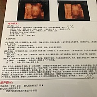 今天才做的四维，报告说胎儿左心室强回声光点！让做羊水穿刺检查，有没有情况一样的宝妈？很着急，不知...