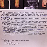 刚刚刷了一下怀孕圈，貌似左心室有强光点的不止我一个，医生说让我等31周再去检查，她说也许是肌肉没长...