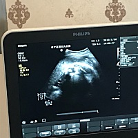 今天37 5天了，做了彩超，问了问医生性别，她没说，打完彩超她就出去了，留下笔录师，我随便看了B超最后...