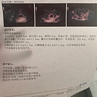 我的B超检查，为什么左右卵巢不一样