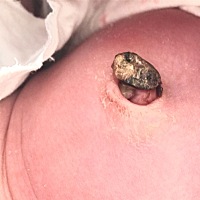 正常吗？还是化脓了