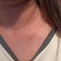 怀孕后脖子都变黑了有好多颈纹，腋下也黑了很多宝妈们有什么招吗？谢谢