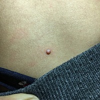 二岁儿子背上长的，一个月前发现了一个，昨天带他去洗澡去发现长出一个，去小医院看说是刺瘊，请有经验...