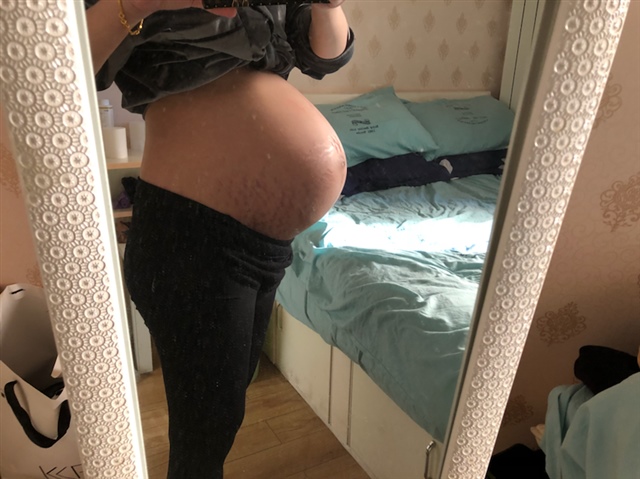 这妊娠纹按我最坏的那个方向长得啊！😣