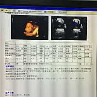 28周去做四维，脐带绕颈了，有没有一样的，问题大吗，医生也没说什么叫我注意什么的