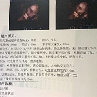 胎盘低置姐妹们有没有这样的。。。能看出男宝女宝么？