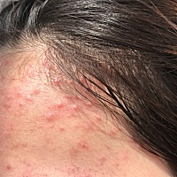 各位姐姐有没有这种情况 目前怀孕3个月 额头两侧一直冒这样的痘痘 又不消下去 看着很恐怖 到底怎么了？