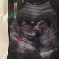 12周 3的Ｎｔ，帮我看看男女吧