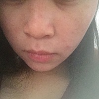 有了宝宝后皮肤动不动就过敏长痘痘或者发红发痒！好烦啊😩