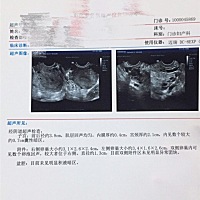 各位亲们，麻烦帮看看B超单，准备要二胎宝宝！谢谢