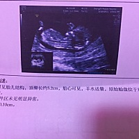 昨天做的nt，12周了，能看出些什么吗，能不能看到宝宝啊，或者能分辨男女吗？