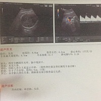 单子显示缺氧？宝宝有多重啊 ？医生说缺氧，吸了半小时氧气 胎心正常了