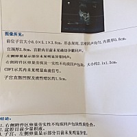 停经39天做吧BC，请问这是宫外孕吗？肚子轻微疼痛，少量咖啡色分泌物！
