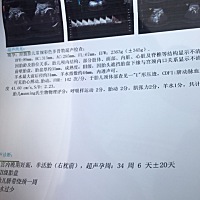 33周➕的时候查出羊水在安全范围的最低值，36周就只有44mm了，期间我是有比平时喝水多。喝水到底能不能...